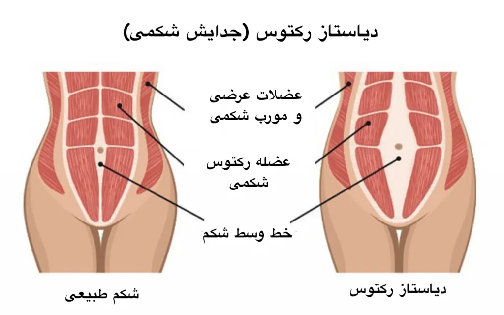 دیاستازرکتی چیست؟